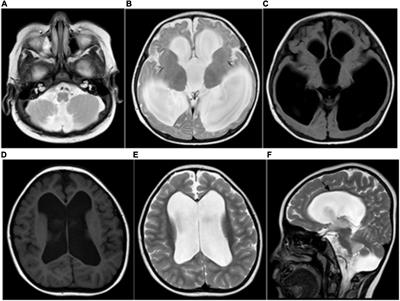 Follow-up study of neuropsychological scores of infant patients with cobalamin C defects and influencing factors of cerebral magnetic resonance imaging characteristics